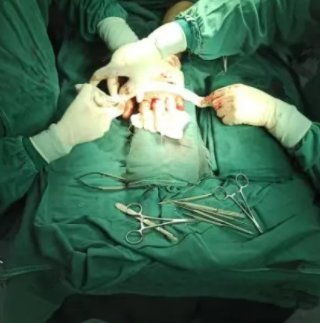 惊险甘肃一男子4根手指被切断赶赴宝鸡后13小时再植成功

