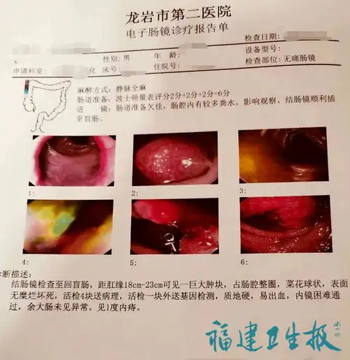 福建男子自以为排便正常,拒绝胃肠镜,1周后被查出肠癌