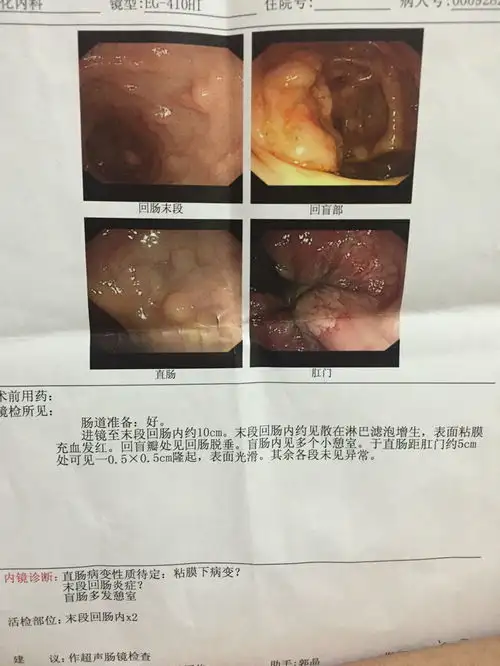 男朋友35岁,之前一直说小腹右侧偶尔疼痛,做了结肠镜,医生说直肠约5厘米处有一个小瘤子,让做ct进