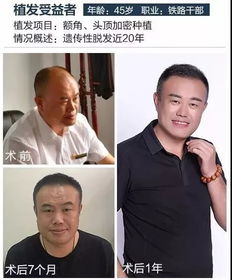 别低头,假发会掉中年男人的脆弱,你想象不到