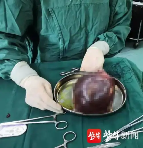 最孝顺的带货婴儿出生带出母亲体内一卵巢囊肿