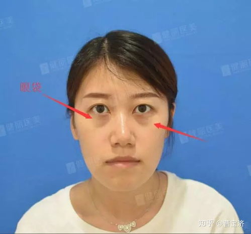20岁40岁究竟什么时候去眼袋效果最好