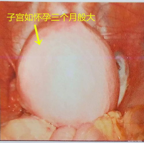 35岁女子十余年不孕,子宫却如怀孕3个月般大,幸亏这位德国朋友及时出手