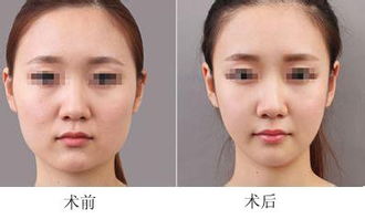 岳阳面部吸脂后表情会变僵硬吗