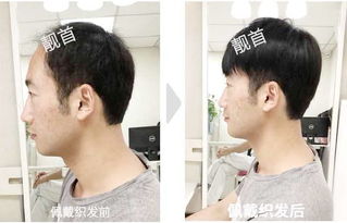 中年男士男士真人假发头顶稀少实拍案例