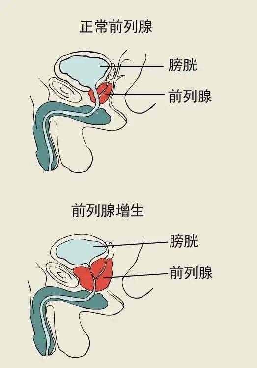 60多岁男人的微信头像前列腺