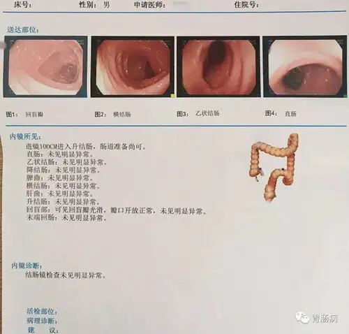 普通肠镜检查并没有想像中的那么可怕我的亲身体验