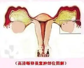 44岁阿姨发福卵巢囊肿让她享不了清福