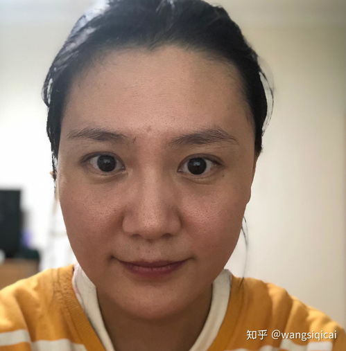 持续更新80后老阿姨面部脂肪填充日记快速消肿期真实猪头照,术后第15天