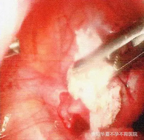 35岁女子十余年不孕,子宫却如怀孕3个月般大,幸亏这位德国朋友及时出手