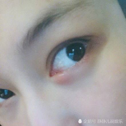 张馨予晒照眼睛肿胀似整容,展现眼睛变大的小技巧