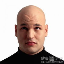 男人为什么会脱发