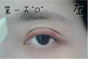 双眼皮,让你拥有一双秋水般的眸子