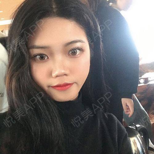 同事们说现在的我看上去小很多,跟18岁似的,哈哈做...瘦脸悦美整形