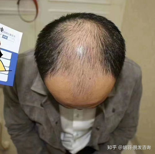 30岁男人脱发严重,是该剃光头还是戴假发